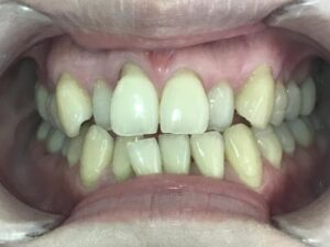 インビザライン治療　症例