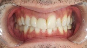 インビザライン治療　症例