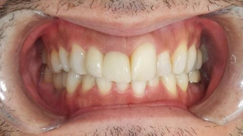 インビザライン治療 症例