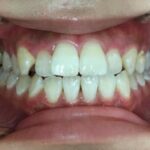 インビザライン治療　症例