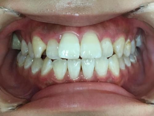 インビザライン治療　症例