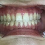 インビザラインGO・セラミック治療　症例