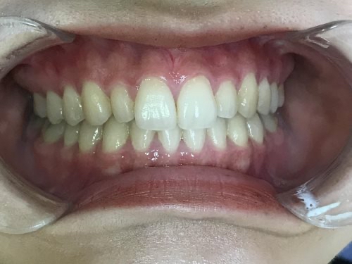 インビザラインGO・セラミック治療　症例