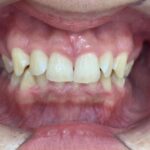 インビザライン治療　症例