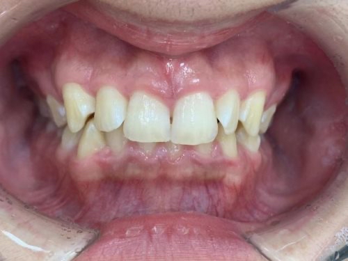 インビザライン治療　症例