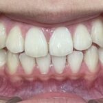 小児矯正　症例