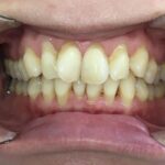 インビザラインGo治療　症例