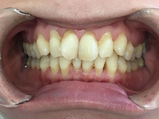 インビザラインGo治療　症例