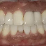 ホワイトニング　症例