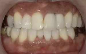 ホワイトニング　症例