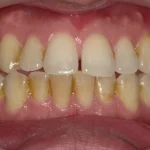 クリーニング　症例