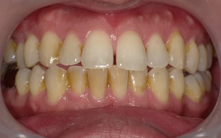 クリーニング 症例