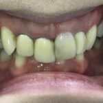 インビザライン矯正と自費補綴　症例