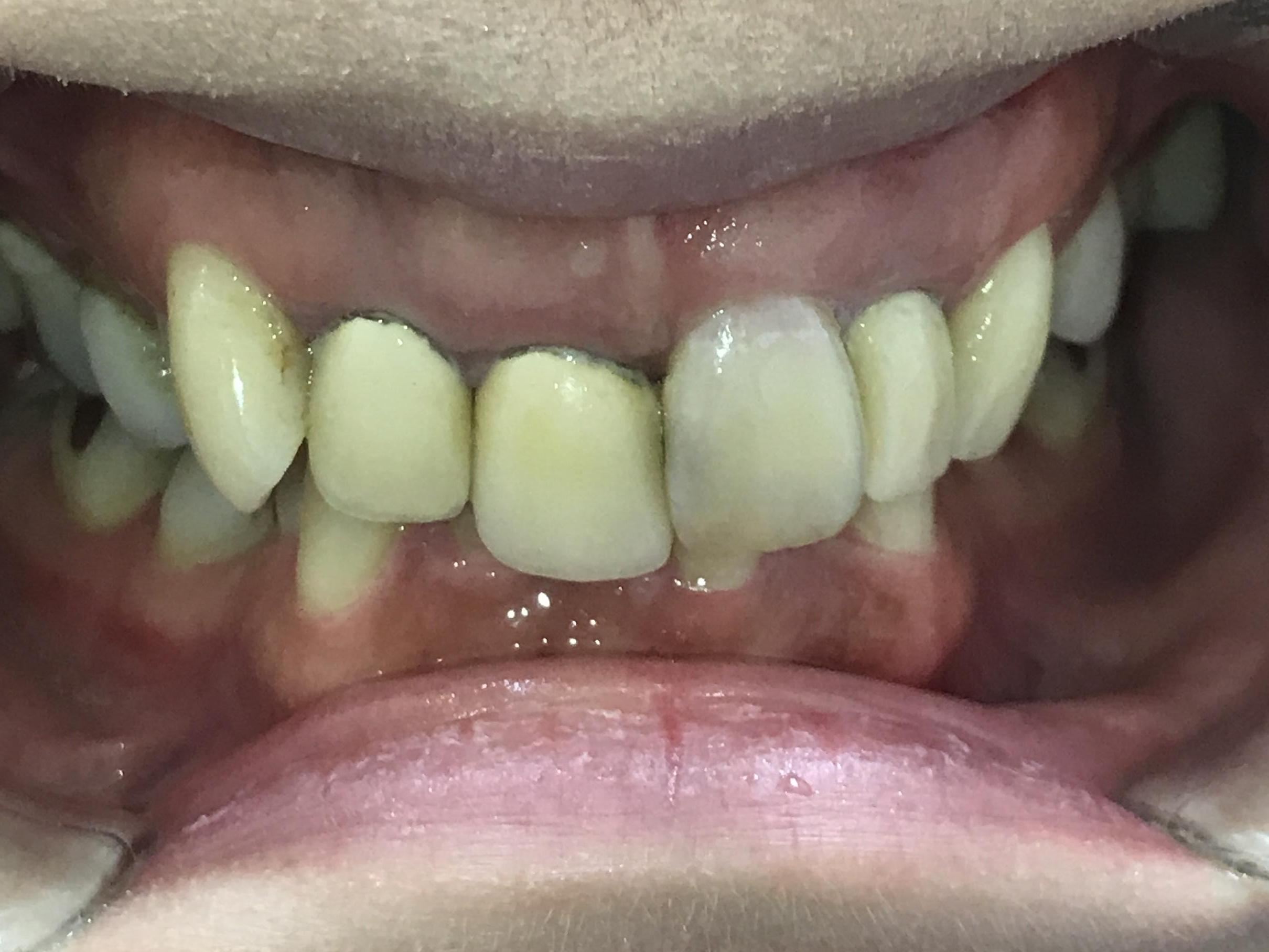 インビザライン矯正と自費補綴 症例