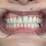 インビザライン治療　症例
