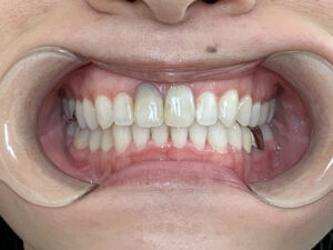 インビザライン治療　症例