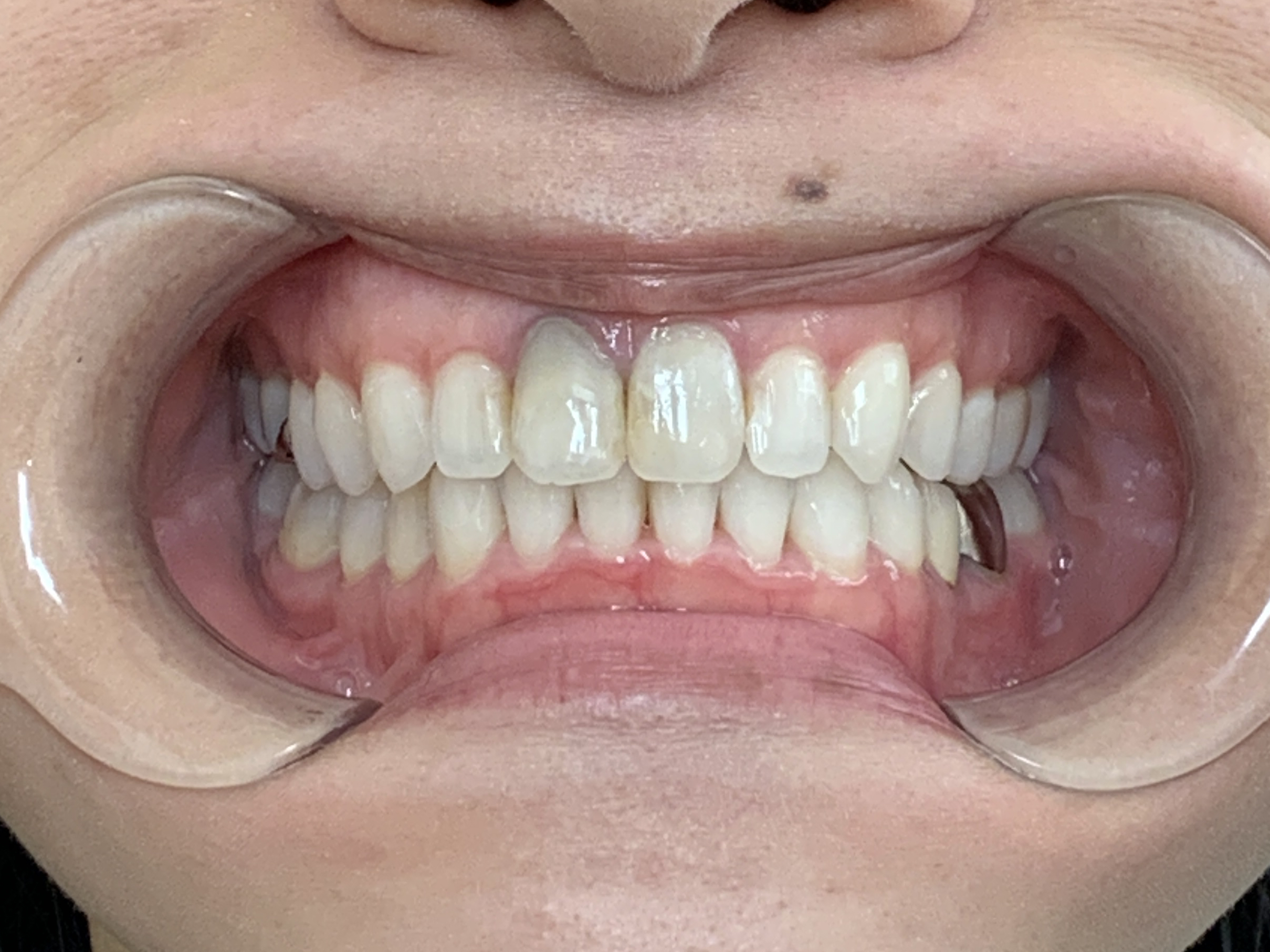 インビザライン治療 症例