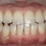 ホワイトニング　症例
