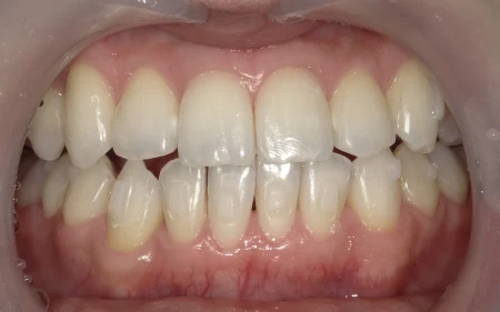 ホワイトニング 症例