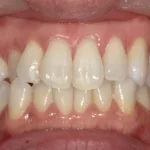 ホワイトニング　症例