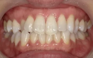 ホワイトニング　症例