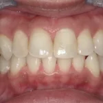 ホワイトニング　症例