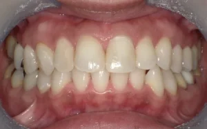 ホワイトニング　症例