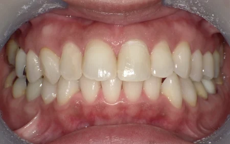 ホワイトニング 症例