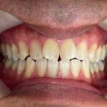 インビザライン治療GO　症例