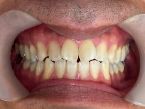 インビザライン治療GO　症例