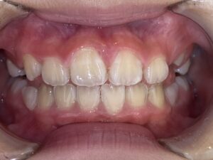 小児矯正　症例