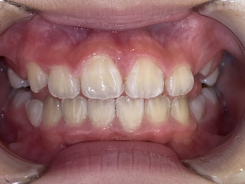 小児矯正　症例