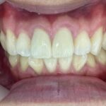 インビザライン治療　症例