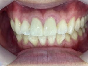 インビザライン治療　症例