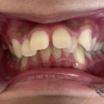 インビザライン治療　症例