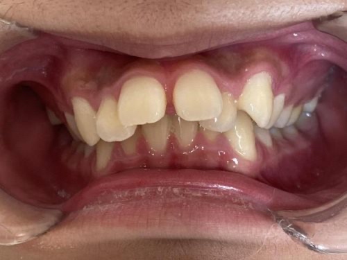 インビザライン治療　症例