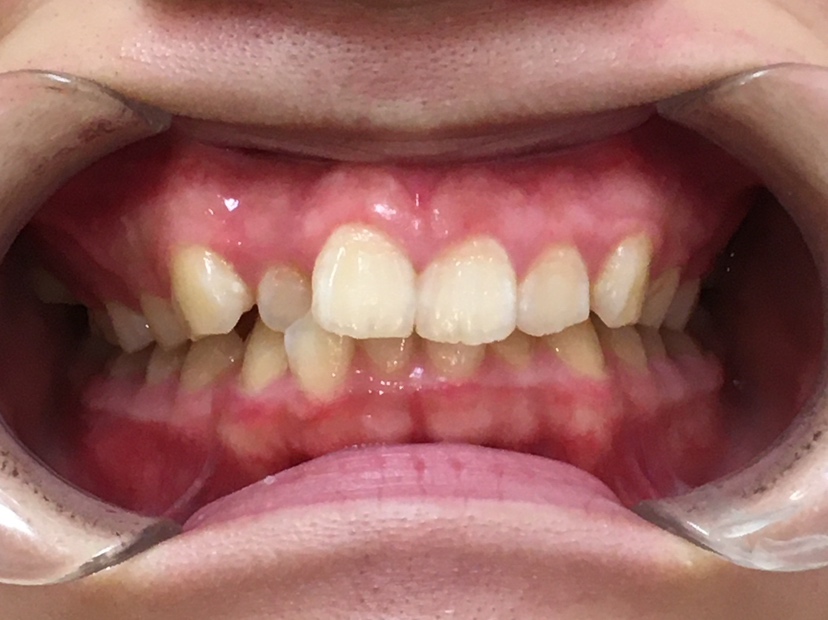 インビザライン治療　症例