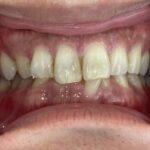 インビザライン治療　症例