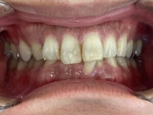 インビザライン治療　症例