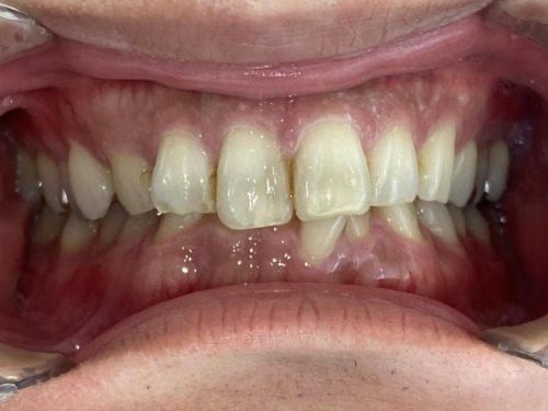 インビザライン治療 症例