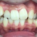 インビザライン治療　症例