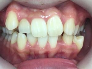 インビザライン治療　症例