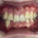 インビザライン治療　症例