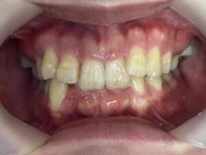インビザライン治療　症例