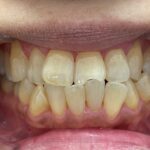 インビザライン治療　症例