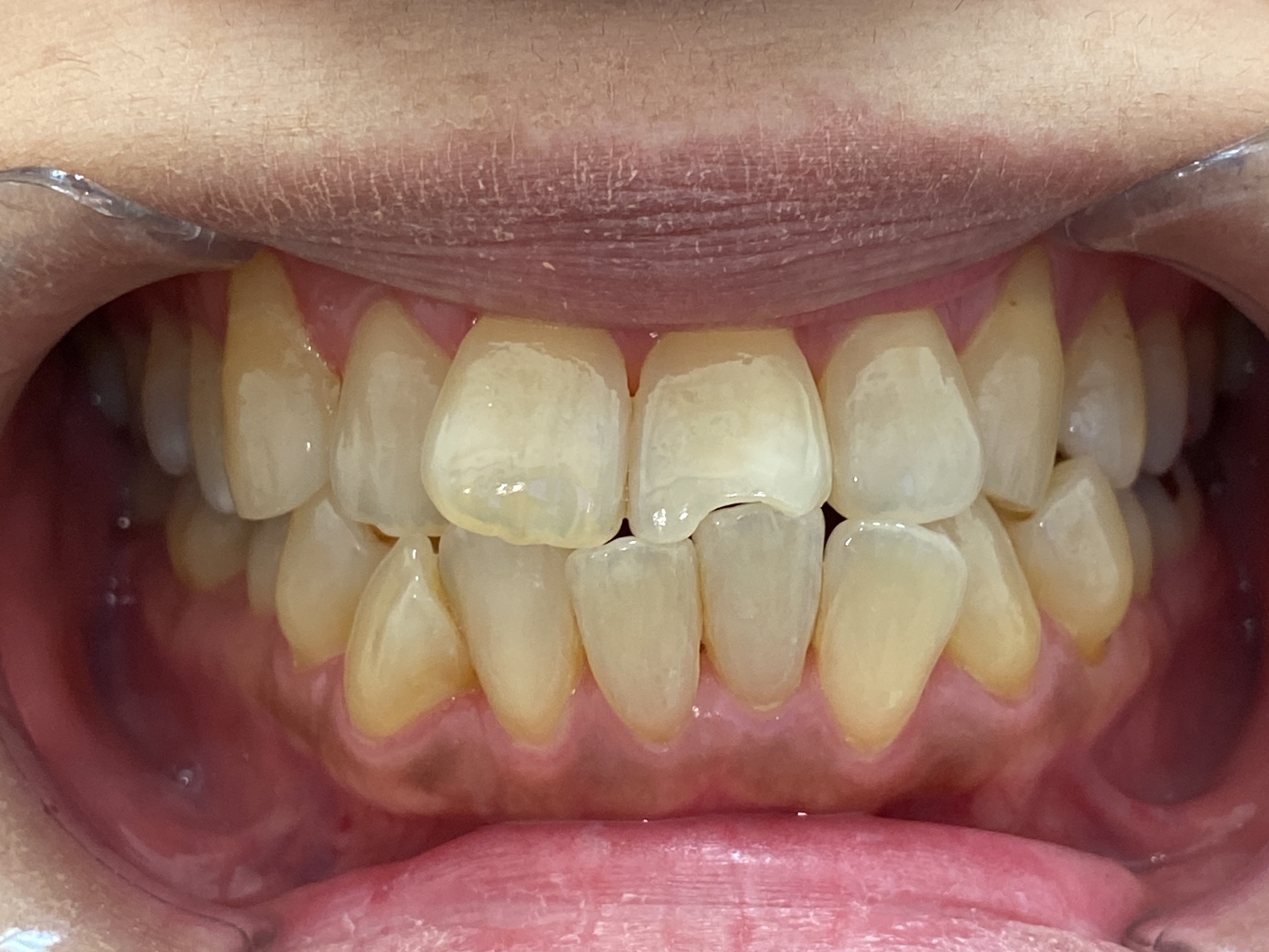 インビザライン治療 症例