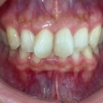 インビザライン治療GO　症例