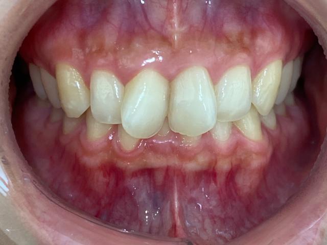 インビザライン治療GO　症例