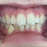 インビザライン治療　症例