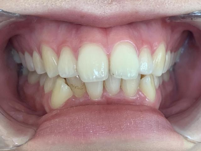 インビザライン治療 症例